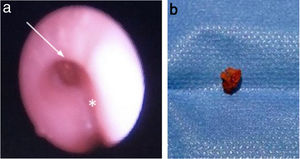 a) Broncoscopia flexible: cuerpo extraño (flecha) en bronquio principal derecho (carina traqueal, asterisco). b) fragmento de caucho extraído de 5 × 4 mm (L × A).