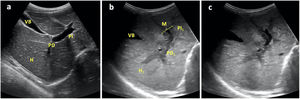 Corte transversal-oblicuo del hipocondrio derecho, obtenido mediante sonda convex a nivel de epigastrio, donde se ponen de manifiesto: a) Parénquima hepático de ecogenicidad homogénea (H), venas porta derecha (PD) e izquierda (PI) y vesícula biliar (VB) normales de un paciente sano; b) Parénquima hepático de ecogenicidad heterogénea (H1), venas porta derecha (PD1) e izquierda (PI1) con manguito hipoecogénico (M) en paciente afecto de LMA; c) Imagen similar a la anterior del mismo paciente sin referencias para visualizar mejor las estructuras referidas.