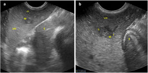 Corte longitudinal-oblicuo del hipocondrio izquierdo, obtenido mediante sonda convex a nivel de epigastrio, en el que se visualizan: a) Parénquima hepático a nivel del lóbulo izquierdo (LHI) con secciones transversales de manguitos periportales hipoecogénicos de mayor (M) y menor tamaño (m); b) Ampliación de la imagen previa con cuantificación del diámetro de uno de manguitos periportales. Estómago (E).