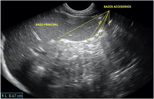 Corte longitudinal del bazo, obtenido mediante sonda convex a nivel de hipocondrio izquierdo, donde se objetivan esplenomegalia (eje esplénico: 8,47cm; límite superior de la normalidad para la edad del paciente: 8cm) y numerosos bazos accesorios en polo inferior del hilio, signo sugerente de neoplasia maligna.