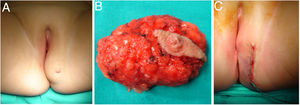 A) Lesión compatible con mama accesoria en vulva, localizada en el labio mayor izquierdo. B) Imagen macroscópica de la pieza quirúrgica con glándula mamaria y complejo aréola-pezón perfectamente desarrollados. C) Excelente resultado estético tras la cirugía.