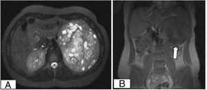 Resonancia magnética abdominal donde se visualiza una gran masa retroperitoneal, bien delimitada. A) En el plano axial se observa captación de contraste en su mayor parte, zonas necróticas y una pequeña zona hemorrágica. B) En el plano coronal se puede ver como la masa contacta con el bazo y el riñón izquierdo.