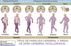 Tipos de PC y áreas de daño cerebral involucrados.