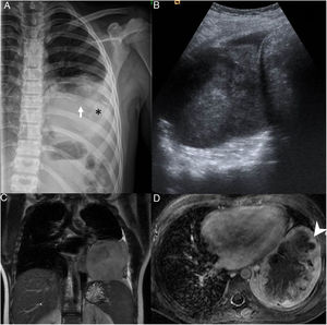 A) Radiografía de parrilla costal muestra infiltración y destrucción parcial del arco posterior de la octava costilla izquierda (flecha blanca), asociando una gran masa de partes blandas intratorácica extrapulmonar con tenues calcificaciones amorfas (*) y discreto derrame pleural acompañante. B) Ecografía de la masa intratorácica heterogénea. C) Resonancia magnética secuencia T2 coronal y D) T1 transversal con saturación grasa y contraste intravenoso, que muestran una masa lobulada en contacto con la pleura mediastínica, pericardio, pleura axilar y diafragmática y realce periférico (punta de flecha) con área de necrosis central.