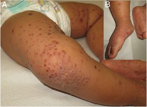A) Lesiones vesículo-ampollosas confluentes a nivel de rodilla con lesiones costrosas en cara interna de muslos. B) Detalle de dorso y planta de pies.