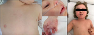 A)Caso 2: exantema en tronco y palmas e hiperemia conjuntival. B)Caso 3: exantema en cara y tronco, y labios agrietados.