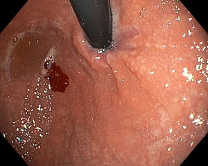 Gastroscopia: mucosa gástrica con aspecto inflamatorio, eritematosa y granular.