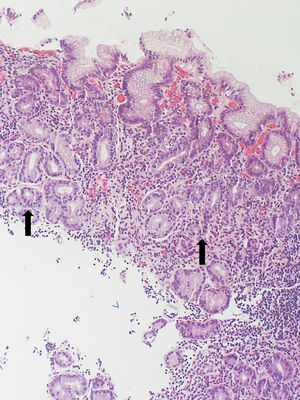 Imagen a ×10 aumentos de mucosa procedente de cuerpo gástrico (tinción de hematoxilina/eosina): atrofia glandular severa, sustituidas por metaplasia pilórica (indicado con flechas). Se visualiza infiltrado de células plasmáticas y linfocitos. No se visualizó Helicobacter pylori en la muestra histológica y el cultivo de dicho microorganismo fue negativo. La biopsia duodenal presentó una histología conservada.