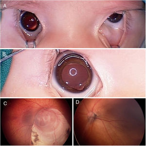 Imágenes de los segmentos oculares anterior y posterior obtenidas bajo anestesia general con el equipo RetCam® 3 (Clarity Medical Systems, Inc., Pleasanton, California, EE. UU.).