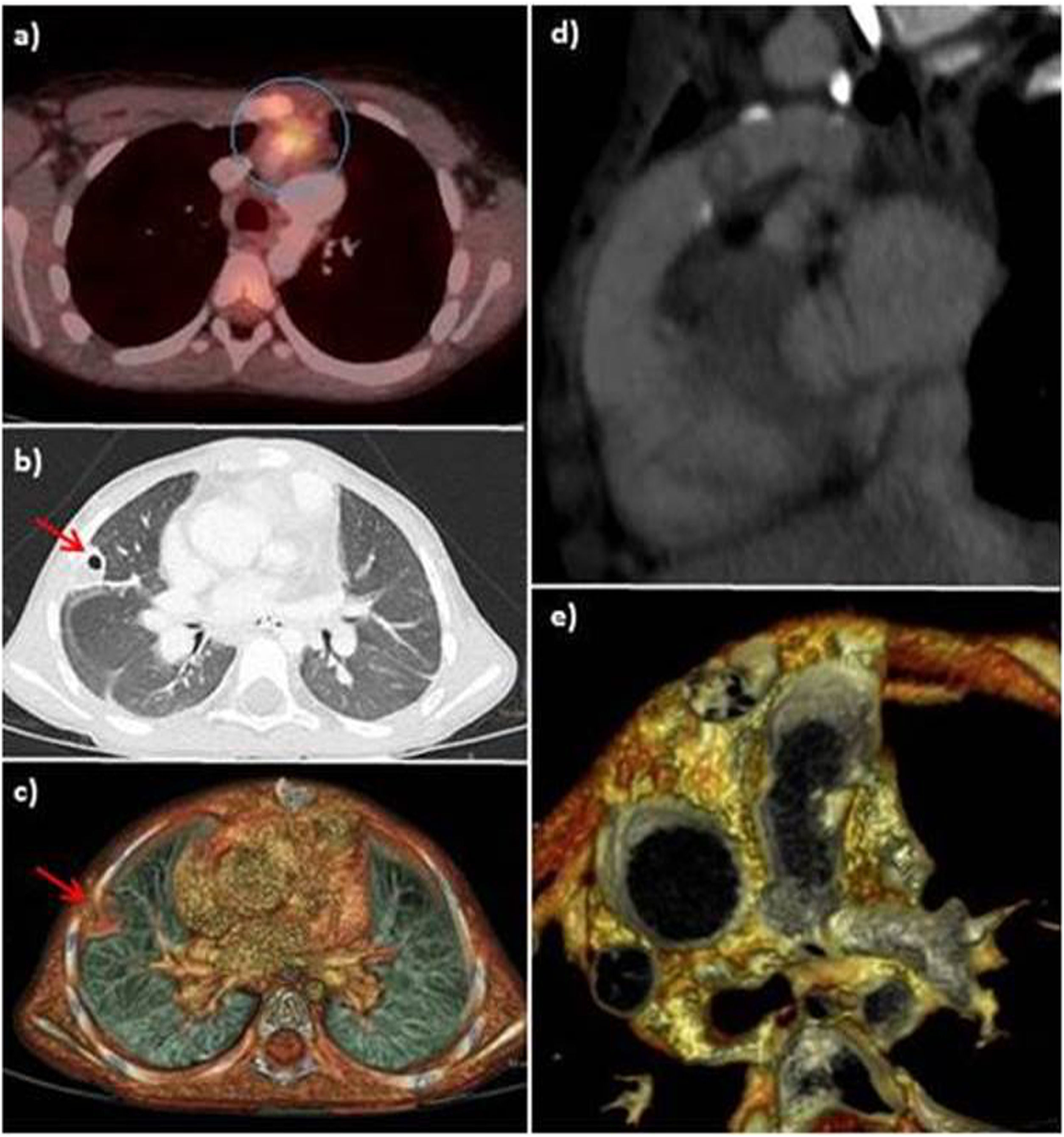 Papel de la PET/TC en el diagnóstico de endocarditis infecciosa en ...