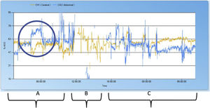 Registro de la saturación regional de oxígeno (rSO2). La rSO2 cerebral se muestra en amarillo y la rSO2 abdominal en azul. A) Registro de NIRS 12h antes de la cirugía con aumento significativo de la rSO2 abdominal y disminución de la rSO2 cerebral que coincidieron con el desarrollo de la perforación gástrica. B) Registro de NIRS intraoperatorio (4h). C) Registro de NIRS a las 12h de la laparotomía y reparación quirúrgica de la perforación gástrica.