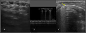 Neumotórax. A/ Plano longitudional anterior. Ausencia de deslizamiento de la línea pleural, ausencia de líneas B y líneas A muy definidas. B/ Modo M. Ausencia de deslizamiento. Signo de la estratosfera: línea pleural y líneas A equidistantes bien definidas. C/ Plano transversal 4-5° espacio intercostal. Punto pulmonar (PP): signo ecográfico que corresponde a la zona de transición entre el neumotórax (ausencia de deslizamiento pleural) y cualquier otro tipo de patrón pulmonar (deslizamiento pleural). Se considera neumotórax ecográficamente leve-moderado si el PP se localiza en línea medio clavicular o línea axilar anterior y grave, si se localiza a partir de línea axilar media.
