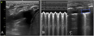 Derrame pleural. A/ signo de la medusa, colapso pulmonar extrínseco por el derrame pleural (contenido anecoico). B/ signo de sinusoide (modo M), se genera por el movimiento de la superficie pulmonar hacia la pleura durante la respiración. C/ Signo del cuadrado (modo 2D): imagen cuadrada donde el derrame pleural es el área anecoica, delimitado por la pleura visceral (abajo) y parietal (arriba) y en los laterales por las sombras costales o el diafragma.