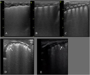 SDR. A, B y C: RNP de 30+2 s. Cesárea urgente, corticoides no administrados. Ecografía pulmonar al ingreso: A/ Plano anterior: patrón alveolo-intersticial homogéneo, sin zonas de aireación (no líneas A) y pleura irregular, pulmón blanco. B/ Plano lateral, hallazgos similares. C/ Plano posterior: patrón AI con engrosamiento pleural y condensaciones subpleurales en la base. D/ Plano transversal con patrón AI difuso con condensaciones subpleurales (flecha). E/ Plano longitudinal posterior con patrón AI con engrosamiento pleural, condensaciones subpleurales y una condensación con broncograma aéreo (atelectasia) de 2 espacios intercostales (EIC) (flecha).