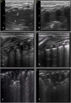 Detección de complicaciones, imágenes condensativas. A y B: Colapso pulmonar/ atelectasia por malposición tubo endotraqueal (TET). A/ Campo anterior izquierdo, desaparición de la línea pleural con patrón de tisulización y broncograma aéreo (hiperecogénico, flecha blanca) y líquido (anecoico, flecha hueca). B/ Campo lateral: desaparición de la línea pleural y tisulización; signo de la sierra (barrera hiperecogénica, interfase pulmón colapsado/pulmón aireado) (estrella). C/ RNP 25 +3 s. DBP. Condensación/atelectasia en campo posterior, broncograma desestructurado. D/ Mismo paciente, control ecográfico a las 2 horas de cambio postural a prono: desaparición de la condensación. E/ RNP 23+5 s. 50 h de vida, condensación en campo posterior izquierdo en contexto clínico de desreclutamiento. F/ Mismo paciente a los 35 ddv, imagen condensativa de aspecto ecográfico similar en contexto clínico compatible con NAV.