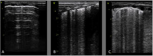 Progresión ecográfica en la primera semana de vida de prematura de 25 semanas cuya madre desarrolló corioamnionitis, y era portadora de U. parvum en exudado cervical. A/ A las 4 horas de vida presenta un patrón normal. B/ Al tercer día de vida ya hay un patrón alveolo-intersticial con engrosamiento pleural y línea pleural fragmentada solo en campos posteriores. C/ A la semana de vida se evidencian estas mismas alteraciones en todos los campos pulmonares. En este tiempo, la paciente apenas presentó empeoramiento de las necesidades de soporte respiratorio, pero a partir de la segunda semana precisó aumento de los parámetros ventilatorios de forma muy agresiva, desarrollando finalmente una DBP grave.
