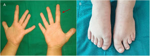 A) Braquidactilia E con afectación de falange media del 2.° dedo de ambas manos más ancha, con forma trapezoidal. B) Braquidactilia E asimétrica en pies.