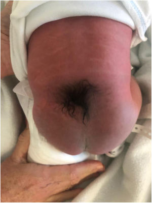 Mechón de pelo en región lumbosacra.
