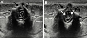 Dos cortes axiales ecográficos consecutivos en la médula lumbar (A y B) a nivel de los hilios renales, en los que apreciamos la existencias de dos hemimédulas (flechas en B). Las imágenes centrales, mediales en cada una de las hemimédulas, puntiformes e hiperecogénicas, corresponden a los respectivos epéndimos (flechas en A). No se aprecia defecto óseo asociado en los elementos lumbares posteriores (flechas negras).