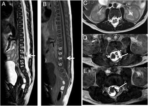 Estudio de RM de columna dorsolumbar. Secuencias sagitales TSE T2 (A) y SE T1 (B) y axiales TSE T2 (C-E). Los cortes sagitales muestran un cono medular descendido que se sitúa a nivel del cuerpo vertebral de L4 (flechas A y B) y muestra alteración de su normal morfología. En la secuencia T1 no se aprecia ningún tipo de lipoma intradural asociado. En los cortes axiales identificamos las dos hemimédulas (flechas cortas en C y D) así como la existencia de un tabique fibroóseo con un trayecto oblicuo (flechas largas en D y E), delimitando dos sacos durales independientes que corresponde a una diastematomielia tipo I con un filum terminal anclado.