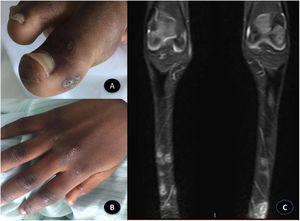 A)Lesiones ulceradas en estadio costroso en el pulpejo y lateral de los dedos de los pies tipo «mordedura de ratón». B)Artritis en articulaciones metacarpofalángicas e interfalángicas proximales de las manos y lesiones en el dorso de los nudillos tipo pápulas de Gottron. C)RM de miembros inferiores, secuencia STIR, plano coronal: lesiones cutáneas en ambos miembros inferiores con morfología pseudonodular y señal patológica brillante que se podrían corresponder con calcinosis.