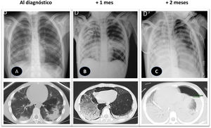 Evolución radiológica de la afectación pulmonar rápidamente progresiva del paciente. Fila superior: radiografía de tórax proyección posteroanterior (A) y portátil anteroposterior (B, C). Fila inferior: TC de tórax sin contraste, ventana de parénquima, plano transversal. A)Condensaciones alveolares con broncograma, patrón parcheado de predominio periférico, en relación con neumonía bilateral multifocal. B)Progresión de la patología pulmonar con áreas extensas de vidrio deslustrado y mayor condensación. Neumomediastino, que ejerce efecto compresivo sobre la cámara cardiaca rectificando el perfil derecho y enfisema celular subcutáneo extenso en tórax superior, cuello y axilas (posible barotrauma). C)Mayor condensación bilateral, extensa en ambos pulmones, que asocia patología pleural (derrame derecho drenado y drenaje del hidroneumotórax izquierdo) con mayor afectación de tejidos blandos torácicos (infiltración y edema). Estudios pre mortem.