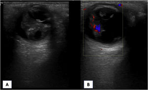 Ecografía oftálmica. Se visualiza masa hiperecoica bilateral retrolental que ocupa toda la cámara vítrea, desplazando hacia delante el cristalino A). La masa presente con captación Doppler B) es compatible con la presencia de vítreo primario hiperplásico bilateral.