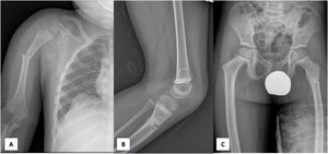 Radiografía AP húmero derecho. A) Se visualiza disrupción y angulación cortical de la diáfisis proximal correspondiente con fractura desplazada. Radiografía lateral rodilla izquierda. B) Se objetiva fractura metafisaria de la tibia. Radiografía de pelvis AP. C) Se pone de manifiesto la disrupción y radiolucencia cortical correspondiente con fractura subtrocantérea del fémur izquierdo sin desplazamiento.