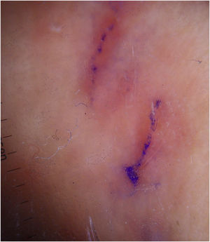 Prueba de la tinta positiva sobre surcos escabióticos.