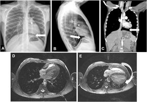 A-C)Radiografía de tórax posteroanterior (A) y lateral (B); TC cardíaca (C); desviación cardíaca hacia la izquierda, con interposición del pulmón entre la salida de la aorta y la arteria pulmonar (*) y presencia de parénquima pulmonar entre el hemidiafragma izquierdo y el margen cardíaco inferior (flecha). D)RM cardíaca con el paciente en decúbito lateral derecho. E)RM cardíaca en decúbito supino mostrando desplazamiento posterior de la silueta cardíaca (flecha).
