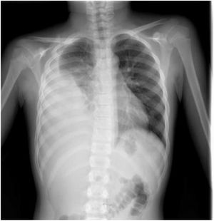 Estudios de imagen. Radiografía simple de tórax. Opacidad extensa en el hemitórax derecho con semiología de derrame pleural (ocupando aproximadamente el 50% del hemitórax), con imágenes compatibles con condensación alveolar en campo medio del pulmón. Ausencia de imágenes derrame pleural o condensaciones en parénquima pulmonar izquierdo.