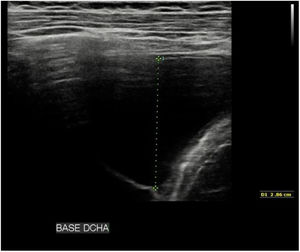 Estudios de imagen. Ecografía torácica: Derrame pleural de hasta 7,5 cm de grosor en la base pulmonar derecha (desde línea media axilar), y de hasta 4 cm de grosor en campo medio derecho. El derrame es predominantemente anecoico, con algunos finos tabiques hiperecogénicos. Se observa alguna zona compatible con parénquima pulmonar condensado/atelectásico en profundidad al derrame.
