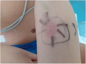 Lectura de Mantoux a las 72 h, 25 mm en diámetro mayor, positivo.