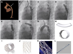 Paciente de 10 años con síndrome de Williams con recoartación de aorta, remitido para implante percutáneo de stent. A y B) Imágenes de TC y angiografía que muestra el estrechamiento de la luz aórtica. C) Avance del stent hasta la zona objetivo. D) Inflado del stent con imagen de zona de infraexpansión a nivel ístmico. E y F) Posdilatación tanto de la zona distal como proximal del stent. G) Comprobación angiográfica. H) Stent Begraft. I) Stent CP covered. J) Stent CP (no cubierto). K) Stent Palmaz Genesis. L) Stent Formula.