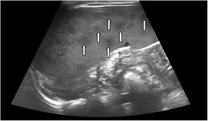 Esplenomegalia con múltiples lesiones hipoecoicas subcentimétricas (flechas) compatibles con nódulos esplénicos.