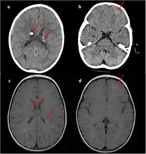 a y b) Tomografía computarizada. c y d) Resonancia magnética cerebral. Se objetivan los nódulos subependimarios bilaterales, con la hiperdensidad propia del calcio en la tomografía computarizada (a y c). Se observa tuberosidad cortical en región fronto-basal izquierda, tanto en tomografía computarizada como en resonancia magnética (b y d).