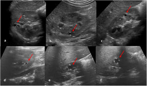 Evolución de los quistes corticales anecoicos. Al diagnóstico, en tercio superior de 3,9mm, en tercio medio (posterior) de 2,5mm y en tercio medio (anterior) de 3mm (a, b y c). A los 3 años del diagnóstico, progresión en el tamaño de los quistes renales (d, e y f) con diámetro máximo de 6,8mm. No se aprecian angiomiolipomas.