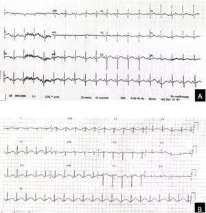 A) Electrocardiograma que muestra un trazado normal tras electrocución con corriente de alto voltaje (1 hora tras el accidente). B) Electrocardiograma del mismo paciente 30 horas tras la electrocución en el que destaca pérdida del ritmo sinusal (ritmo nodal), con alargamiento del QTc.