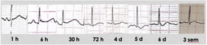 Evolución del trazado electrocardiográfico tras electrocución de alto voltaje (derivación III). Se objetiva un trazado normal al ingreso, con posterior aparición de onda J de Osborn (6h), alargamiento del QTc y ritmo nodal (30h), aplanamiento progresivo y descenso de ST, con normalización posterior.