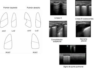 Protocolo de ecografía pulmonar con exploración de 6 áreas torácicas y figuras utilizadas en el módulo de formación.
