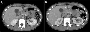 A)Primer TAC con contraste: bandas fluidas en epigastrio y mesogastrio. Antro, bulbo y primera porción duodenal contraídos, con pared engrosada. Sin claro neumoperitoneo. Engrosamiento de la pared vesicular. B)TAC con contraste de control día +7: burbuja de gas ectópico en epigastrio, sugerente de perforación duodenal contenida (flecha). Evolución favorable con disminución de las bandas fluidas, atenuación grasa y engrosamiento de pared, manteniéndose engrosamiento del antro-píloro.