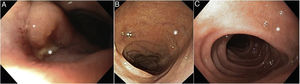 A)Imagen endoscópica al diagnóstico. Úlcera (asterisco) en bulbo duodenal de aproximadamente 2cm de diámetro mayor, cubierta de fibrina, con mínimo sangrado, de bordes eritematosos y edematosos. Resto de la mucosa duodenal de aspecto normal. B)Control mes +4. Cicatrización de lesión ulcerosa previa. C)Control mes +8. Región cicatricial de úlcera previa curada.