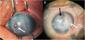 (A) Apariencia de la córnea del ojo derecho tras la cirugía. Hifema visible a pesar del edema difuso de la córnea. La flecha indica la localización de la sutura en la córnea. (B) Tras la extracción del cristalino: mayor transparencia de la córnea, fibrosis residual secundario a traumatismo (flecha blanca) y burbuja de aire en la cámara anterior del ojo al final de la cirugía (flecha negra).
