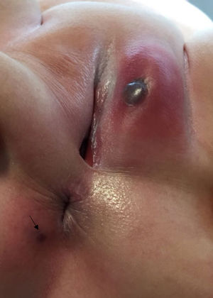 Lesión típica de ectima gangrenoso: lesión bullosa bien demarcada con área central necrótica y base hinchada eritematosa en los genitales. Pequeña lesión necrótica en el margen anal (flecha).