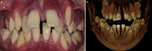 Vista frontal de la dentadura del paciente que expone los dientes flotantes asociados con el enrojecimiento de las encías. Imágenes de TC 3D que muestran la ausencia de proceso alveolar en todos los dientes y lesiones osteolíticas en la mandíbula.