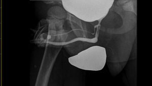 Cistouretrografía miccional: duplicación uretral tipo 2 coronal completa según la clasificación de Lima et al.1.