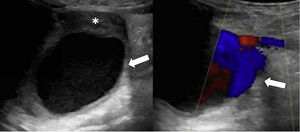 Aneurisma de arteria poplítea (flecha) con trombo mural en cara posterior (asterisco), con buen flujo arterial distal.
