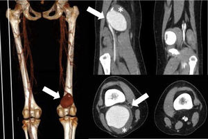 Aneurisma de 5,7 x 5 x 7,6 cm (flecha), con trombo (asterisco) y calcificaciones murales. Tronco tibio peroneo arterial permeable, no signos indirectos de trombosis. No otros aneurismas visibles.