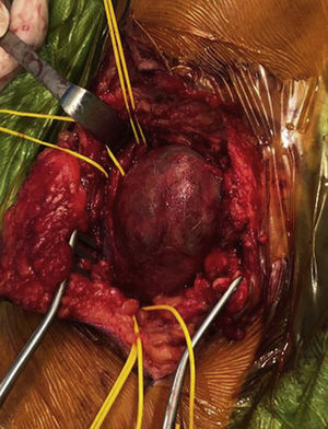 Aneurisma sacular íntegro de arteria poplítea con segmento proximal y distal disecados de calibre normal.