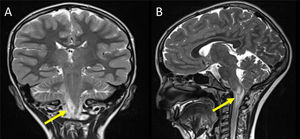 Resonancia magnética craneal que muestra un glioma pontinomedular de bajo grado en el lado derecho (flecha) afectando al núcleo sensorial del nervio trigémino (caso 1). A: coronal T2; B: sagital T2.